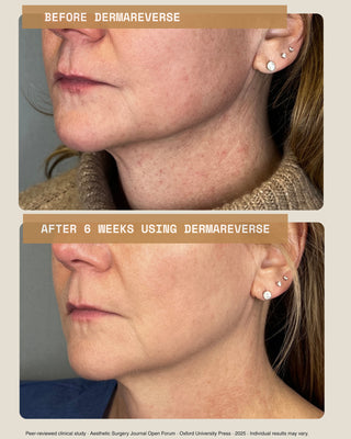 Before and after profile photos of a study participant's jaw and neck, before DermaReverse and after 6 weeks of use, from a peer-reviewed clinical study